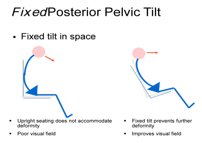 Fixed Posterior Pelvic Tilt. Fixed tilt in space: Upright seating does not accommodate deformity. Poor visual field. Fixed tilt prevents further deformity. Improves visual field.