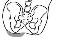 Fixed Pelvic Obliquity